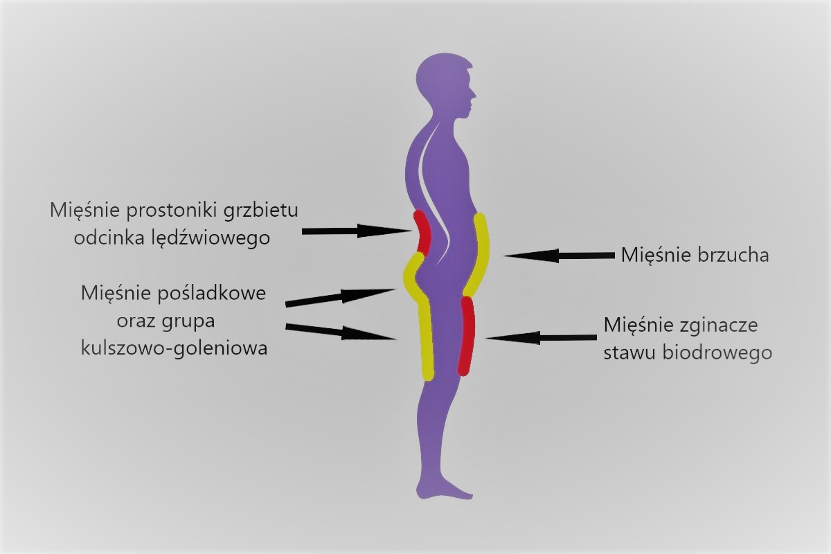 hiperlordoza lędźwiowa2