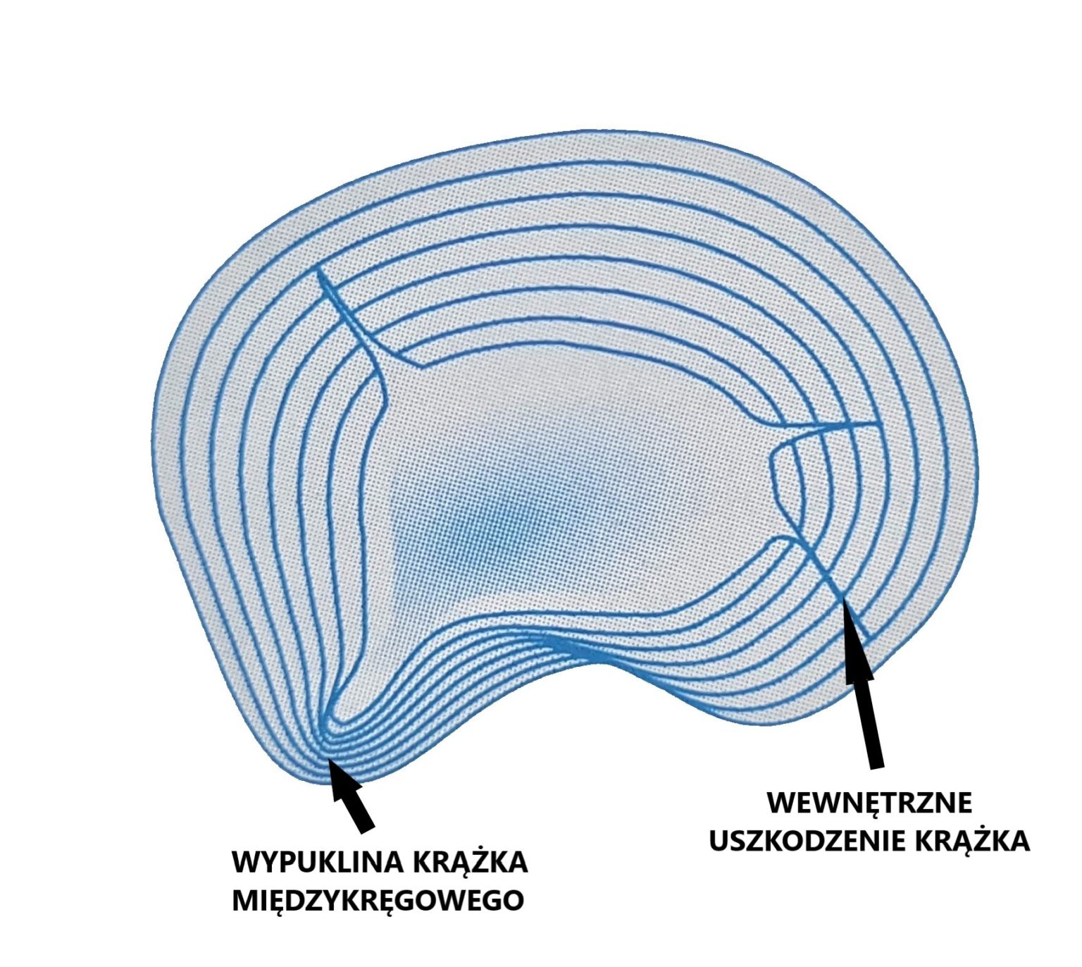 krążek strktura protruzja 1536x1372