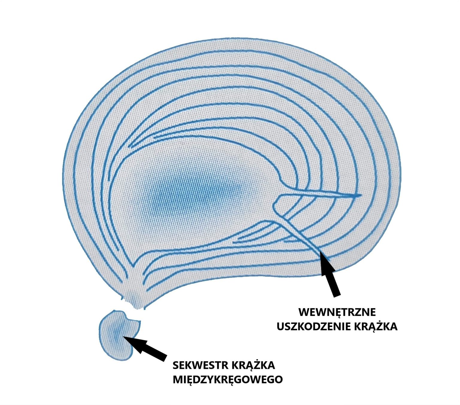 krążek strktura sekwestr 1536x1354