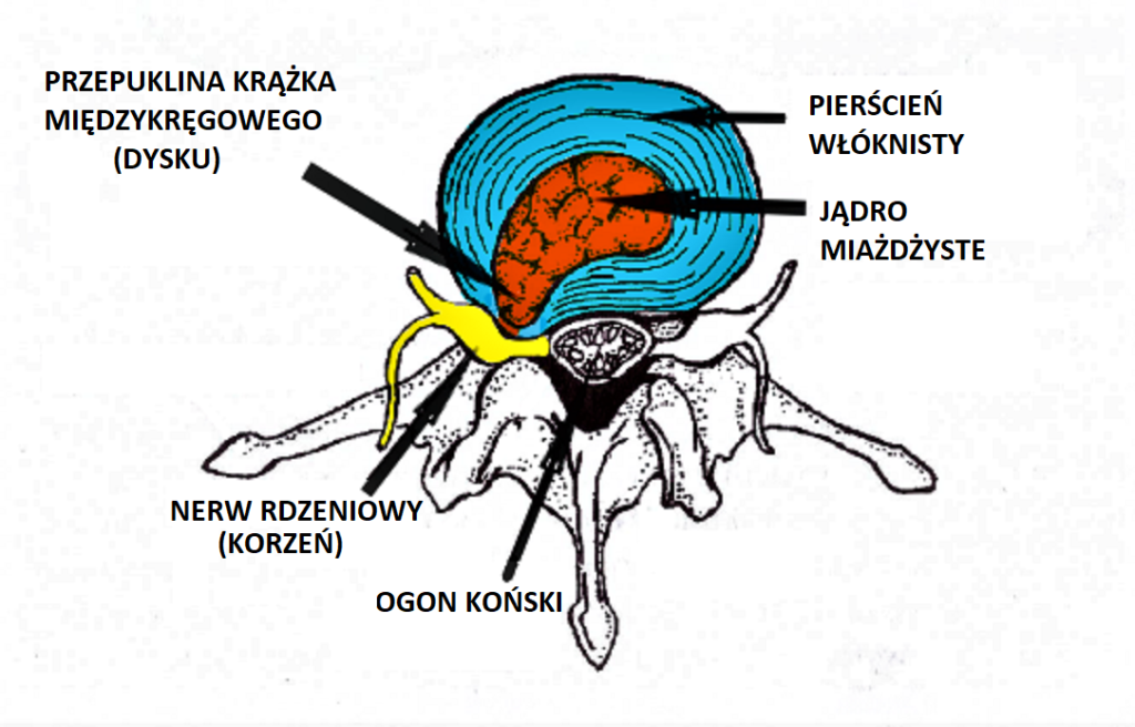 Przepuklina krążka międzykręgowgo 1024x656